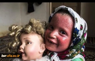 گزارش جمع آوری کمک برای کودک بیمار پوستی