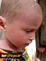 بیماری نرگس رسولی رو به بهبودی است